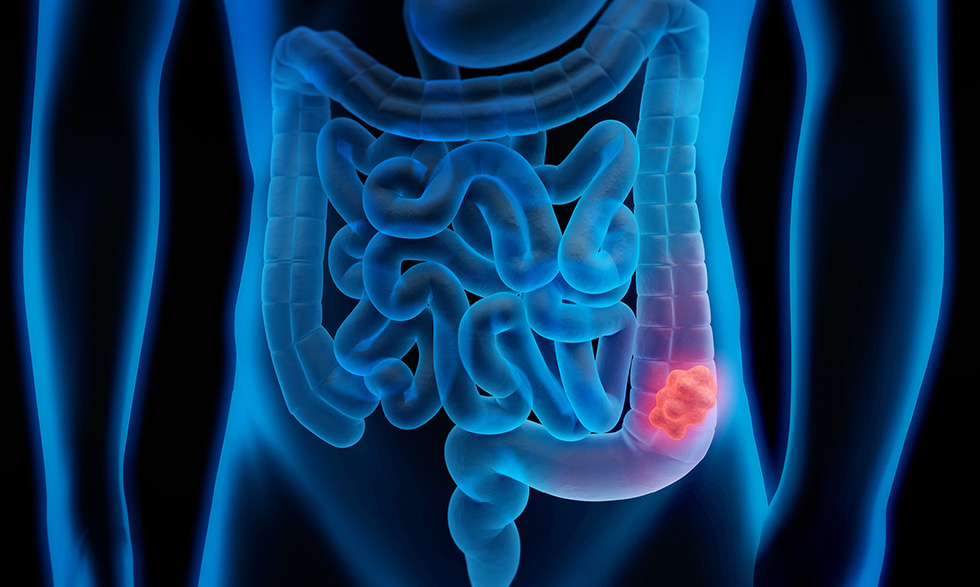 Salud Pública llama a la detección temprana del cáncer colorrectal