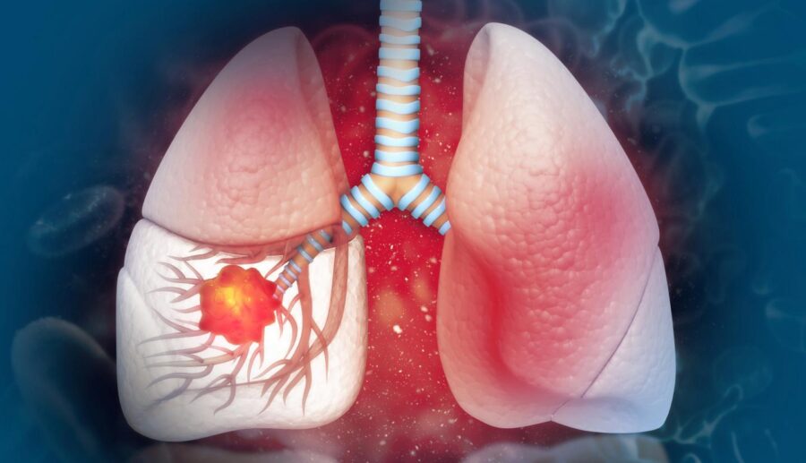 Humo que mata: 80% cáncer pulmón se asocia al tabaco