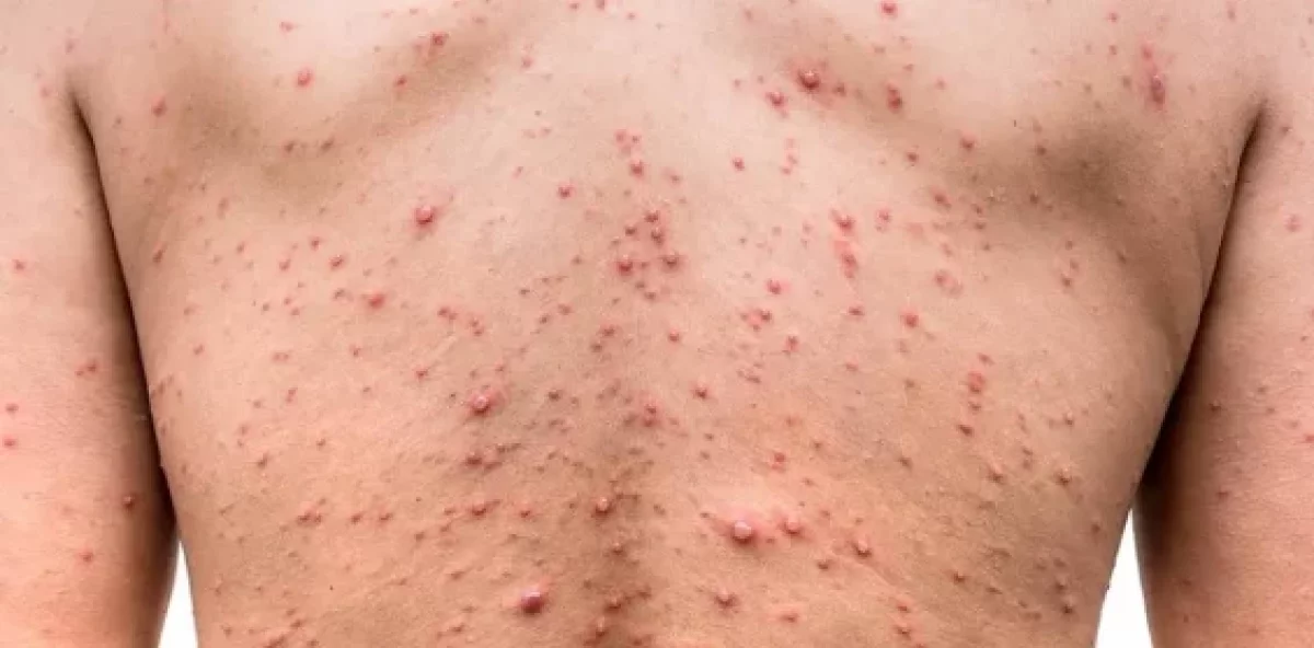 ¿Qué es el mpox y cómo se transmite en RD? Ya hay dos casos
